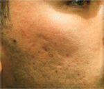 Secret Fraxis RF MicroNeedling