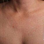Non-Surgical Skin Tightening
