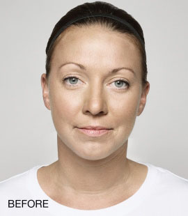Lip Rejuvenation