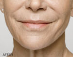 Lip Rejuvenation