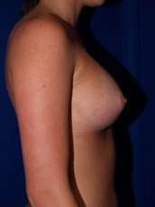 Breast Augmentation