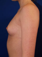 Breast Augmentation