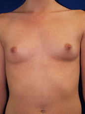 Breast Augmentation