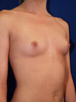 Breast Augmentation