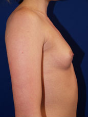 Breast Augmentation