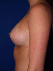 Breast Augmentation