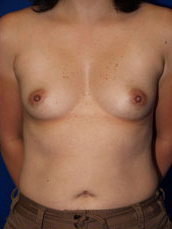Breast Augmentation