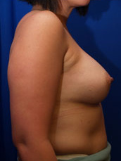 Breast Augmentation