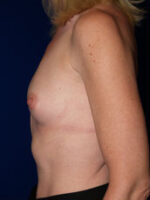 Breast Augmentation