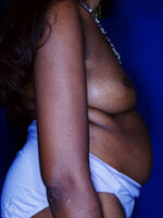 Breast Fat Transfer