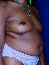 Breast Fat Transfer