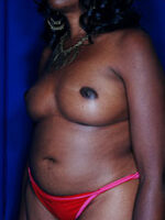 Breast Fat Transfer
