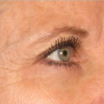 Non-Surgical Skin Tightening