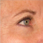 Non-Surgical Skin Tightening