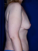 Breast Fat Transfer