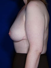 Breast Fat Transfer