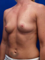 Breast Augmentation