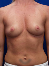 Breast Augmentation