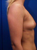 Breast Augmentation