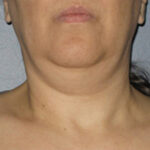 Non-Surgical Skin Tightening