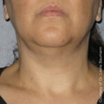 Non-Surgical Skin Tightening
