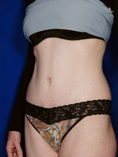 Abdominoplasty