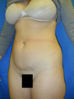 Abdominoplasty
