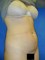 Abdominoplasty