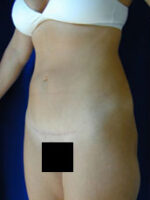 Abdominoplasty
