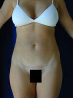 Abdominoplasty