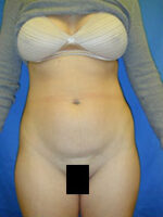 Abdominoplasty