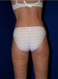 Body Lift