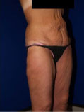 Body Lift