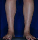 Calf Ankle Liposuction