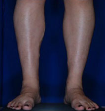 Calf Ankle Liposuction