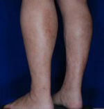 Calf Ankle Liposuction