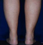Calf Ankle Liposuction