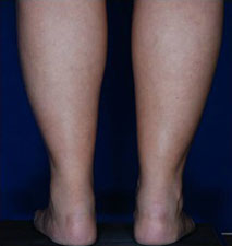 Calf Ankle Liposuction