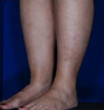 Calf Ankle Liposuction