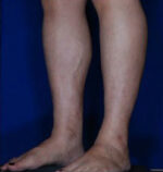 Calf Ankle Liposuction