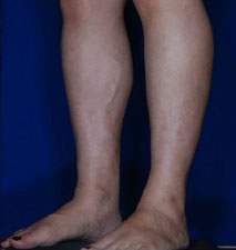 Calf Ankle Liposuction