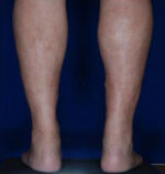 Calf Ankle Liposuction