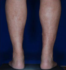 Calf Ankle Liposuction