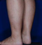 Calf Ankle Liposuction