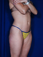 Liposuction