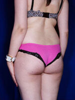 Liposuction
