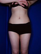 Liposuction