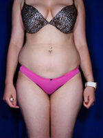Liposuction
