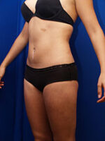 Liposuction