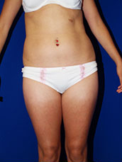 Liposuction